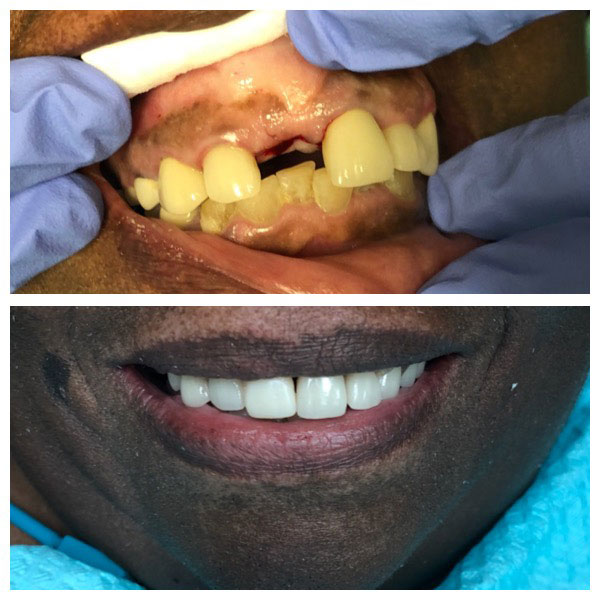 Before and After Dental Implants #1 Photo