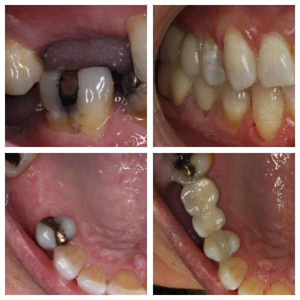 Before and After Dental Implants #2 Photo