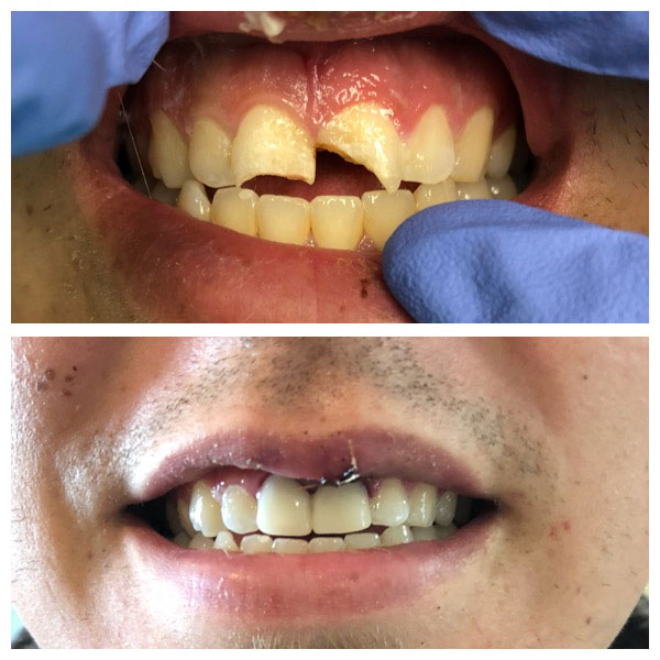 Before and After Same-Day Crowns #2 Photo