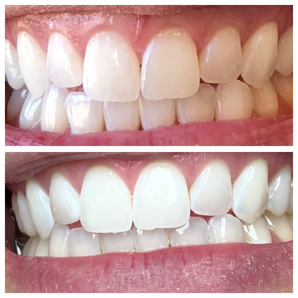 Before and After Teeth Whitening #1 Photo