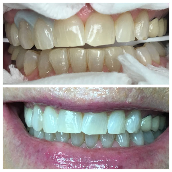 Before and After Teeth Whitening #2 Photo