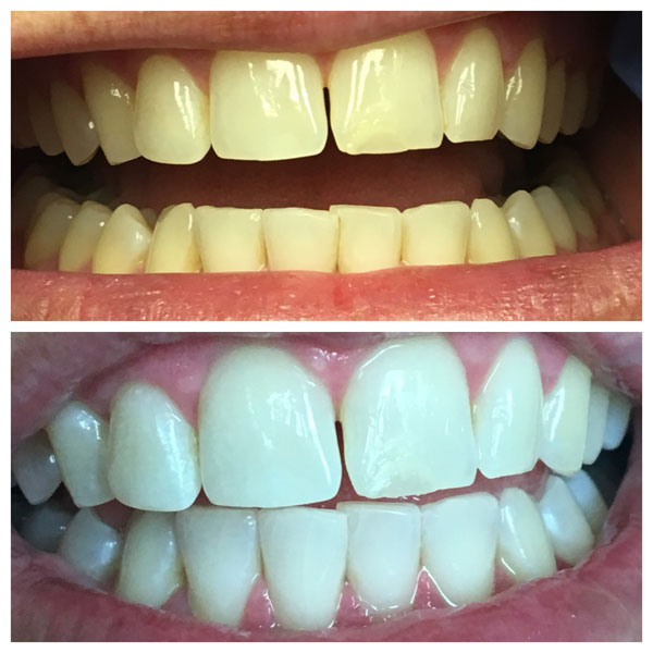 Before and After Teeth Whitening #3 Photo