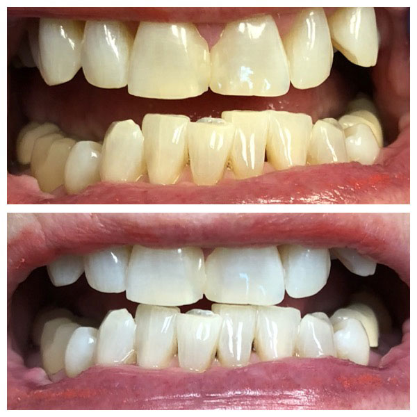 Before and After Teeth Whitening #4 Photo