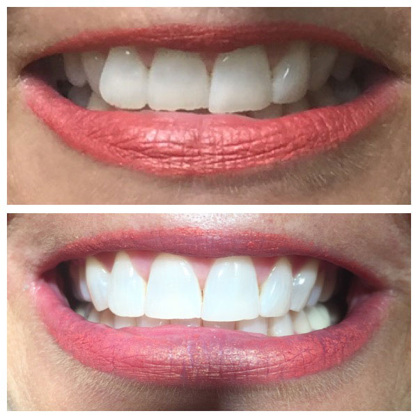 Before and After Teeth Whitening #5 Photo